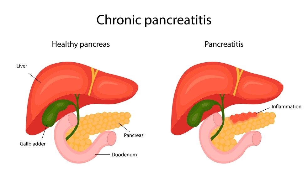 Everything You Need to Know About Pancreatitis